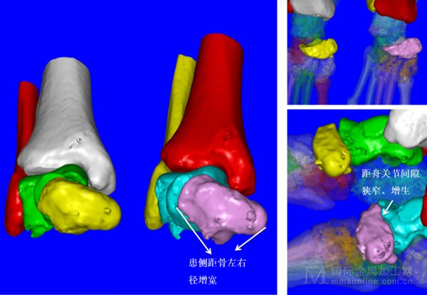 借助3D技术的三维设计手术治疗方案④-1-1024x707.jpg