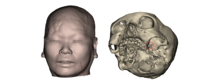 三维重建颅骨示意图